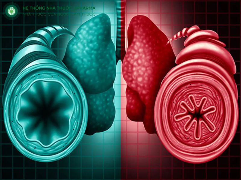 viêm phế quản dạng hen