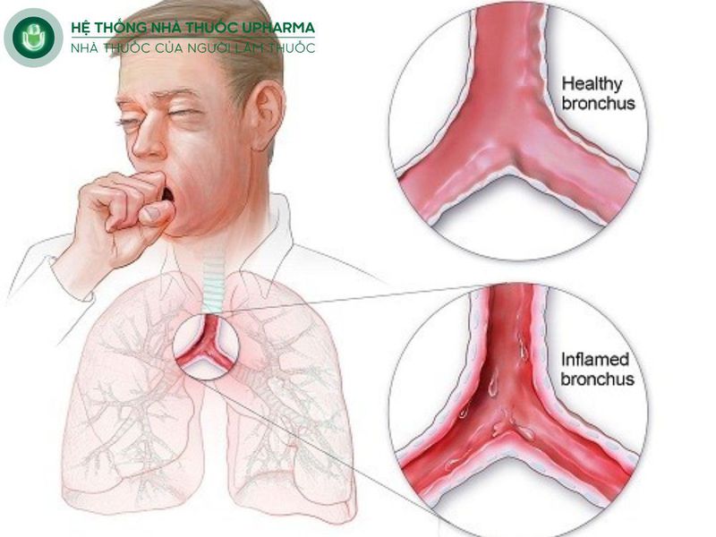 viêm phế quản cấp