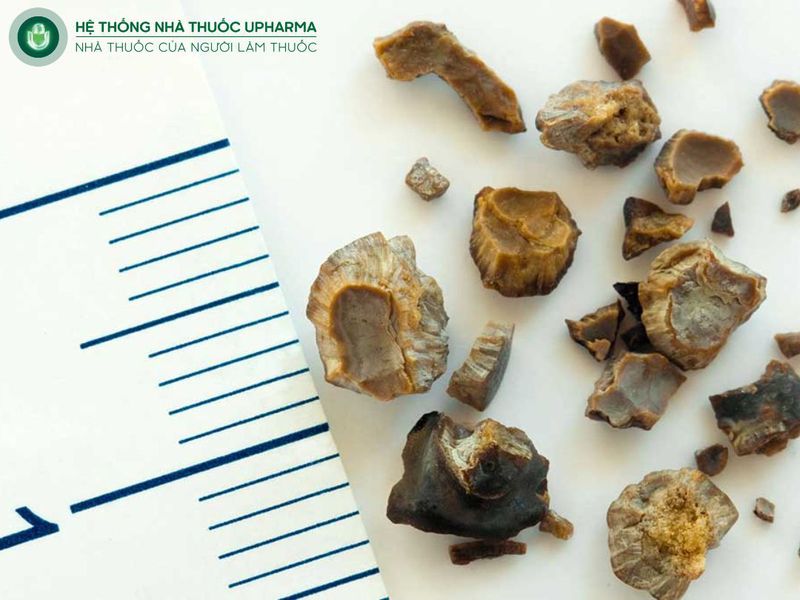 yếu tố quyết định mổ sỏi thận